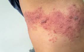 Herpes (HSV-1/HSV-2)