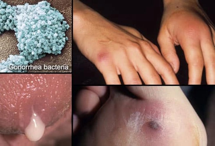 STD infection का medical reference image