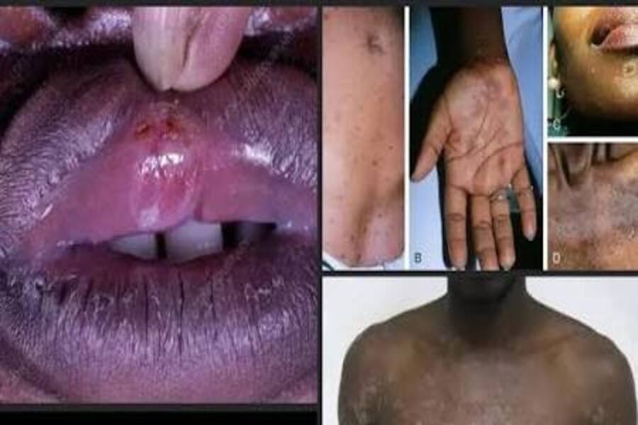 कई संभावित STD symptoms का medical awareness collage