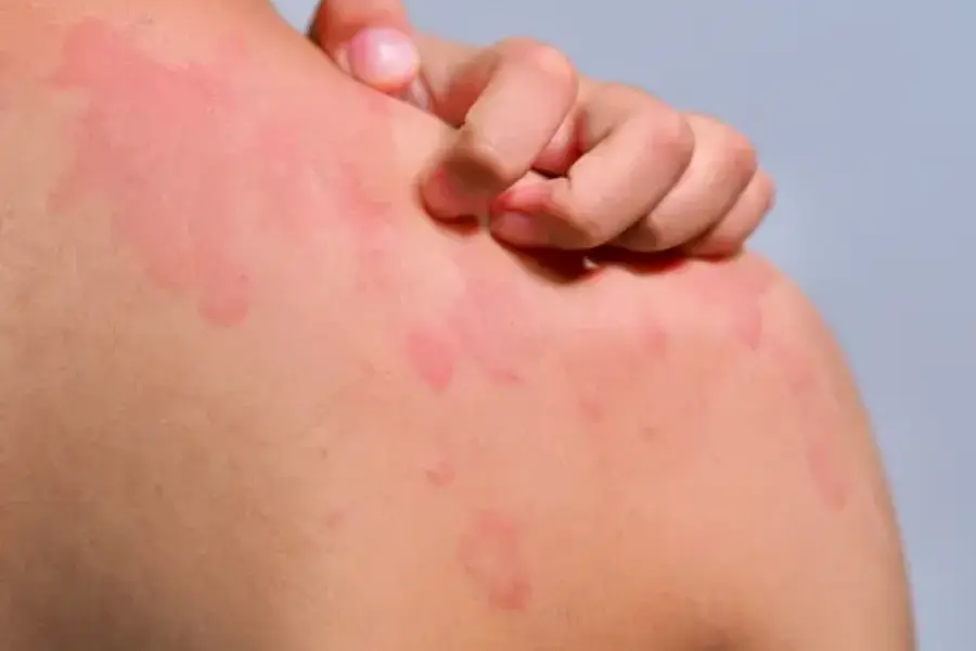 Skin rash और खुजली का health awareness image