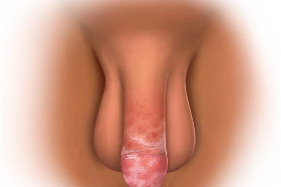 Male genital swelling और irritation का medical illustration